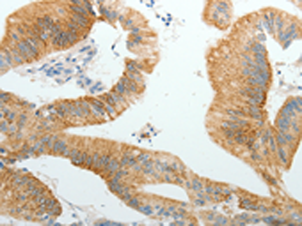 Immunohistochemistry of paraffin-embedded Human colon cancer tissue using TA324238 (PGBD5 Antibody) at dilution 1/10 (Original magnification: x200)