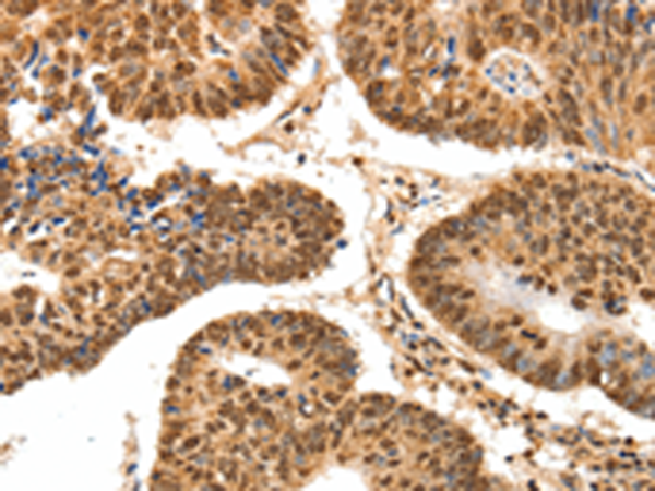 Immunohistochemistry of paraffin-embedded Human colon cancer tissue using TA324240 (SPATA20 Antibody) at dilution 1/70 (Original magnification: x200)