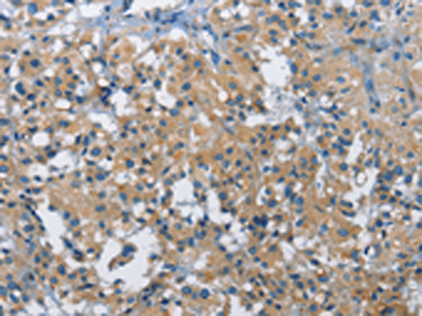 Immunohistochemistry of paraffin-embedded Human thyroid cancer tissue using TA349261 (BMPR1B Antibody) at dilution 1/30 (Original magnification: x200)