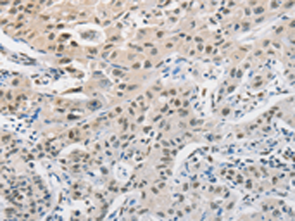 Immunohistochemistry of paraffin-embedded Human lung cancer tissue using TA349270 (CDC27 Antibody) at dilution 1/50 (Original magnification: x200)