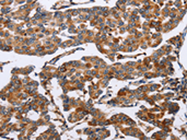 Immunohistochemistry of paraffin-embedded Human breast cancer tissue using TA349306 (ENPP5 Antibody) at dilution 1/60 (Original magnification: x200)