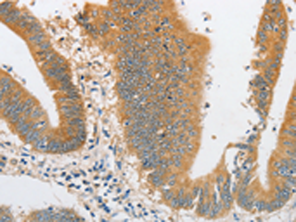 Immunohistochemistry of paraffin-embedded Human colon cancer tissue using TA349503 (ARHGAP5 Antibody) at dilution 1/30 (Original magnification: x200)