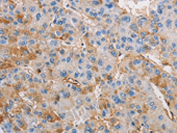 Immunohistochemistry of paraffin-embedded Human liver cancer tissue using TA349513 (DIRAS3 Antibody) at dilution 1/25 (Original magnification: x200)