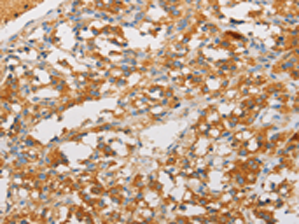 Immunohistochemistry of paraffin-embedded Human thyroid cancer tissue using TA349537 (ART3 Antibody) at dilution 1/40 (Original magnification: x200)
