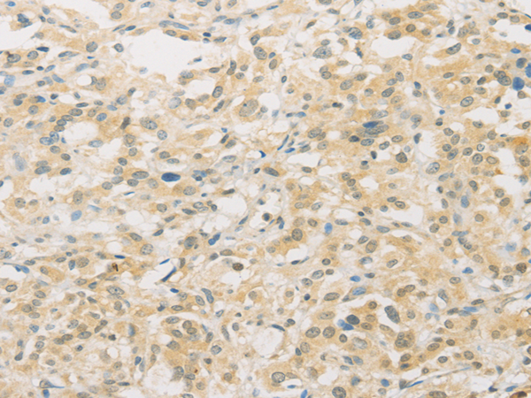 Immunohistochemistry of paraffin-embedded Human thyroid cancer tissue using TA349563 (FNTA Antibody) at dilution 1/30 (Original magnification: x200)