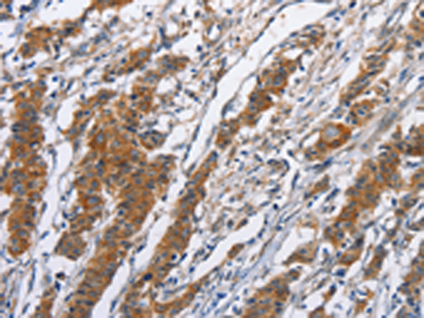 Immunohistochemistry of paraffin-embedded Human gasrtic cancer tissue using TA349741 (NCAPD3 Antibody) at dilution 1/50 (Original magnification: x200)