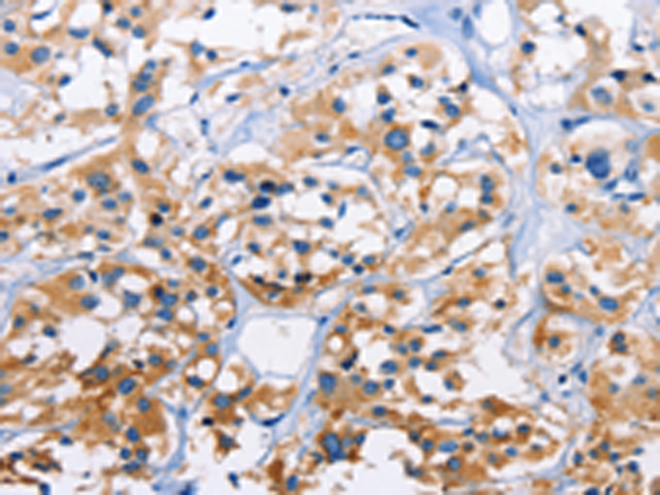 Immunohistochemistry of paraffin-embedded Human thyroid cancer tissue using TA349743 (CAPZA3 Antibody) at dilution 1/70 (Original magnification: x200)