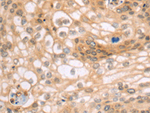 Immunohistochemistry of paraffin-embedded Human cervical cancer tissue using TA349750 (CATSPER1 Antibody) at dilution 1/70 (Original magnification: x200)
