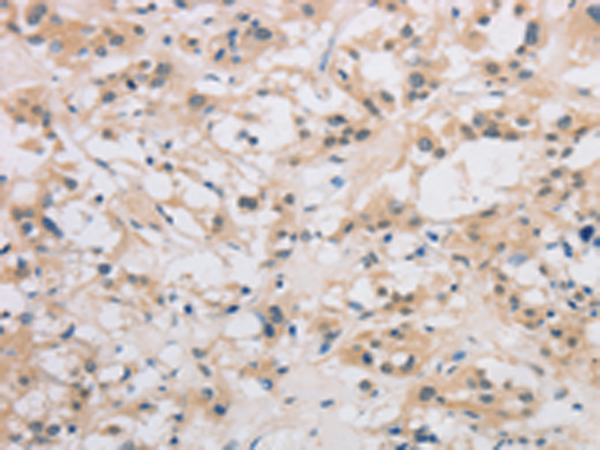 Immunohistochemistry of paraffin-embedded Human thyroid cancer tissue using TA349880 (DDIT4L Antibody) at dilution 1/40 (Original magnification: x200)
