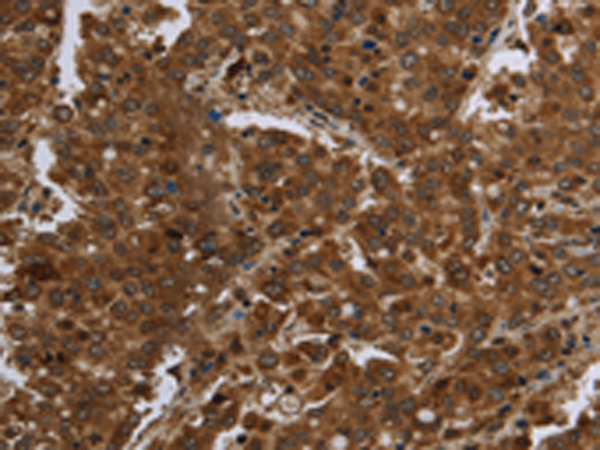 Immunohistochemistry of paraffin-embedded Human liver cancer tissue using TA349966 (FASTKD1 Antibody) at dilution 1/60 (Original magnification: x200)
