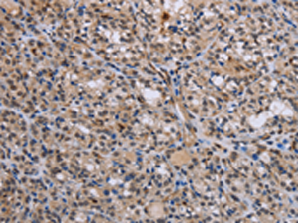 Immunohistochemistry of paraffin-embedded Human thyroid cancer tissue using TA350003 (GADD45A Antibody) at dilution 1/30. (Original magnification: x200)