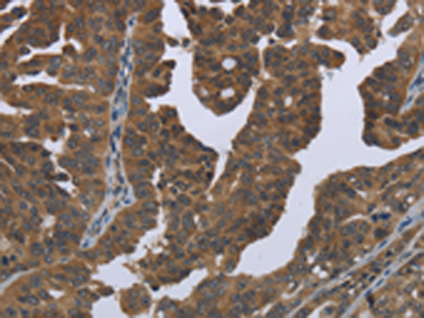 Immunohistochemistry of paraffin-embedded Human ovarian cancer tissue using TA350029 (GYS2 Antibody) at dilution 1/50 (Original magnification: x200)