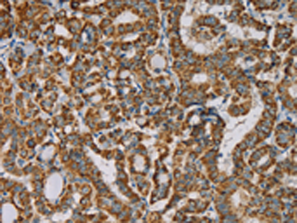Immunohistochemistry of paraffin-embedded Human thyroid cancer tissue using TA350092 (IPO13 Antibody) at dilution 1/25 (Original magnification: x200)