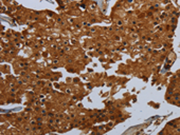 Immunohistochemistry of paraffin-embedded Human prostate cancer tissue using TA350173 (ENTPD7 Antibody) at dilution 1/60 (Original magnification: x200)