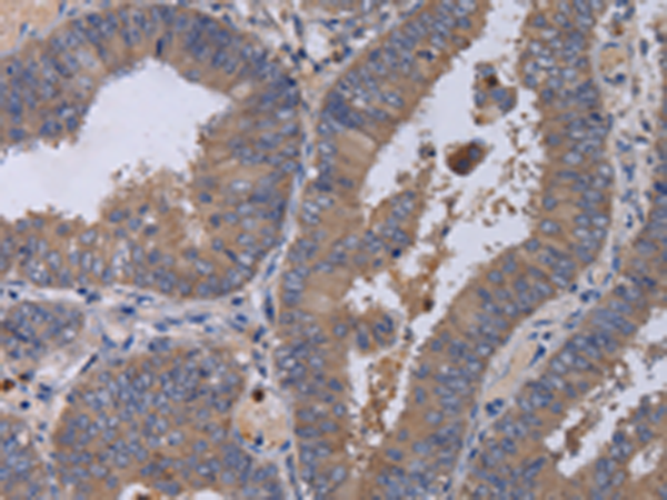 Immunohistochemistry of paraffin-embedded Human colon cancer tissue using TA350179 (MKKS Antibody) at dilution 1/50 (Original magnification: x200)