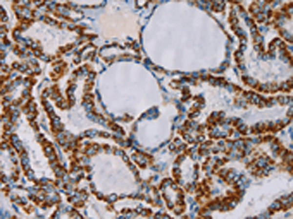 Immunohistochemistry of paraffin-embedded Human thyroid cancer tissue using TA350188 (CMC4 Antibody) at dilution 1/55 (Original magnification: x200)