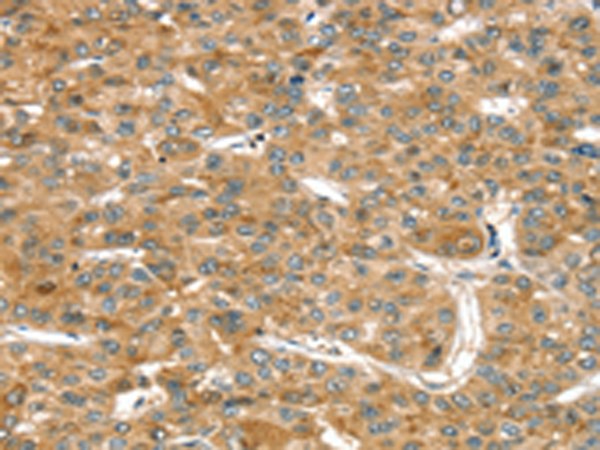 Immunohistochemistry of paraffin-embedded Human liver cancer tissue using TA350331 (RASSF9 Antibody) at dilution 1/45 (Original magnification: x200)
