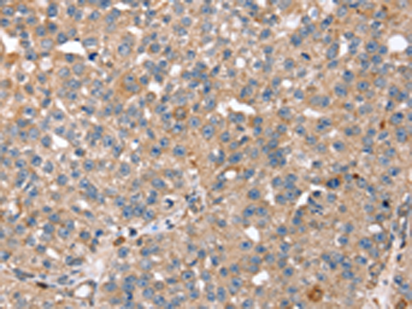 Immunohistochemistry of paraffin-embedded Human breast cancer tissue using TA350360 (RNF11 Antibody) at dilution 1/40 (Original magnification: x200)