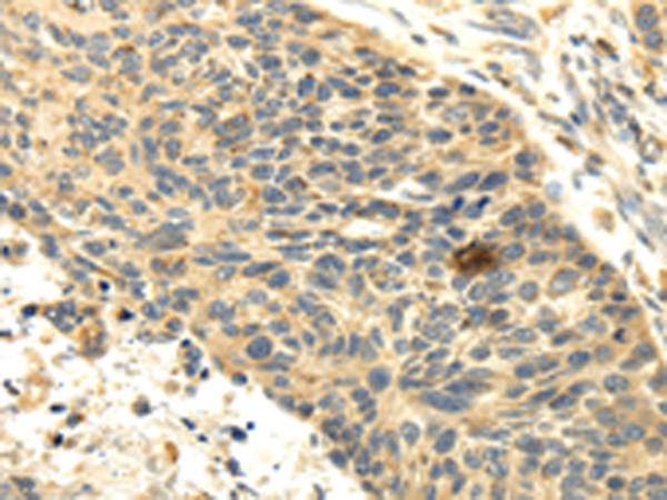 Immunohistochemistry of paraffin-embedded Human esophagus cancer tissue using TA350397 (SEMA4F Antibody) at dilution 1/35 (Original magnification: x200)