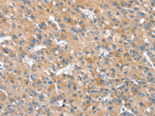 Immunohistochemistry of paraffin-embedded Human liver cancer tissue using TA350423 (SLC25A2 Antibody) at dilution 1/20 (Original magnification: x200)