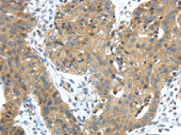 Immunohistochemistry of paraffin-embedded Human breast cancer tissue using TA350522 (TMPRSS11E Antibody) at dilution 1/45 (Original magnification: x200)