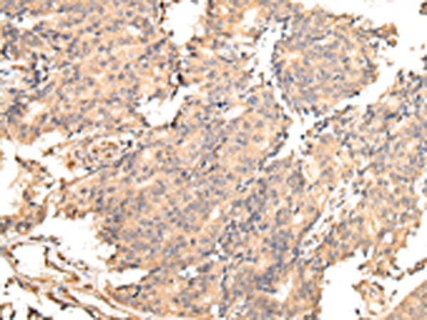 Immunohistochemistry of paraffin-embedded Human prostate cancer tissue using TA350570 (UGGT2 Antibody) at dilution 1/25 (Original magnification: x200)