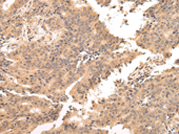Immunohistochemistry of paraffin-embedded Human prostate cancer tissue using TA350591 (USP45 Antibody) at dilution 1/25 (Original magnification: x200)