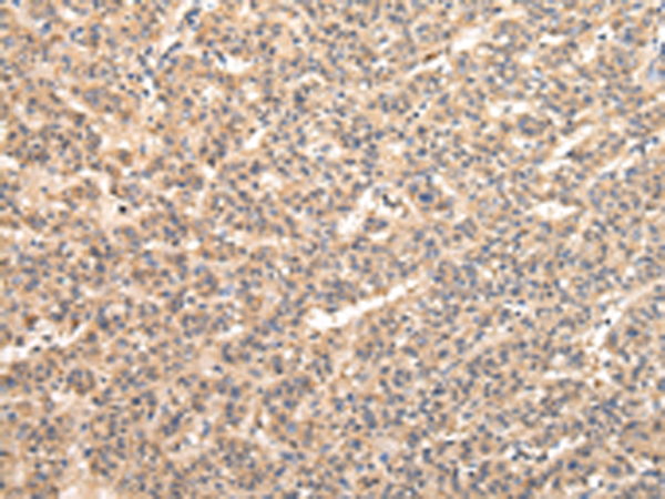 Immunohistochemistry of paraffin-embedded Human liver cancer tissue using TA350613 (VPS33B Antibody) at dilution 1/40 (Original magnification: x200)