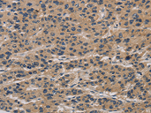 Immunohistochemistry of paraffin-embedded Human liver cancer tissue using TA350637 (CLEC2A Antibody) at dilution 1/20 (Original magnification: x200)