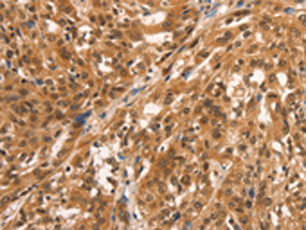 Immunohistochemistry of paraffin-embedded Human esophagus cancer tissue using TA350647 (CCNE2 Antibody) at dilution 1/25 (Original magnification: x200)