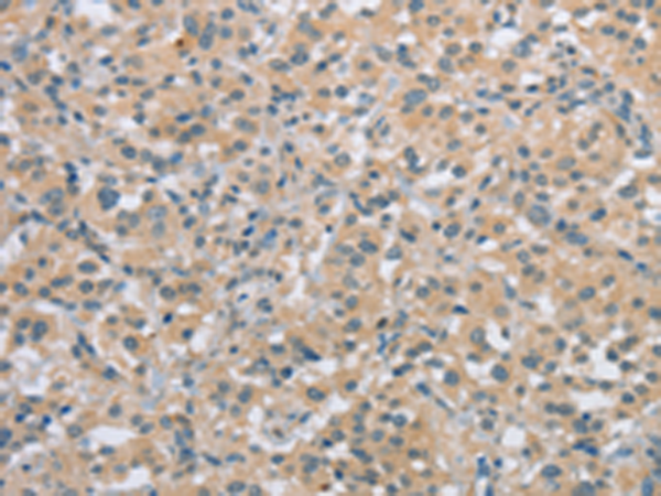 Immunohistochemistry of paraffin-embedded Human thyroid cancer tissue using TA350656 (ECRG4 Antibody) at dilution 1/20 (Original magnification: x200)