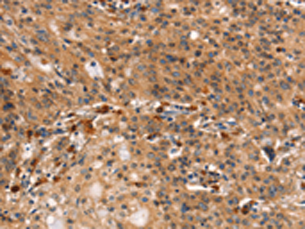 Immunohistochemistry of paraffin-embedded Human gasrtic cancer tissue using TA350756 (DCLK1 Antibody) at dilution 1/25 (Original magnification: x200)