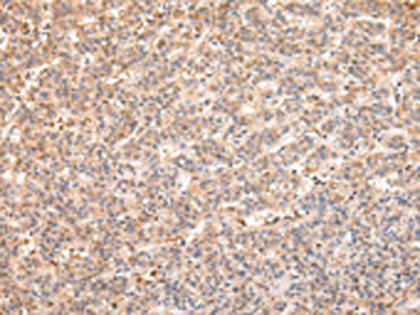 Immunohistochemistry of paraffin-embedded Human liver cancer tissue using TA350825 (RERE Antibody) at dilution 1/25 (Original magnification: x200)