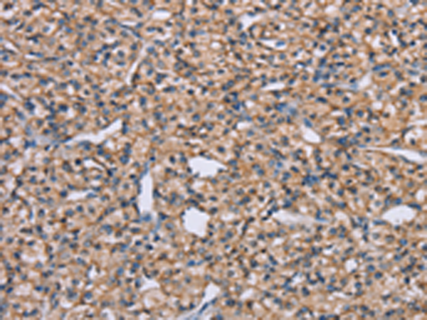 Immunohistochemistry of paraffin-embedded Human prostate cancer tissue using TA350846 (ADAM29 Antibody) at dilution 1/40 (Original magnification: x200)