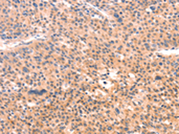 Immunohistochemistry of paraffin-embedded Human liver cancer tissue using TA350859 (APBA2 Antibody) at dilution 1/80 (Original magnification: x200)