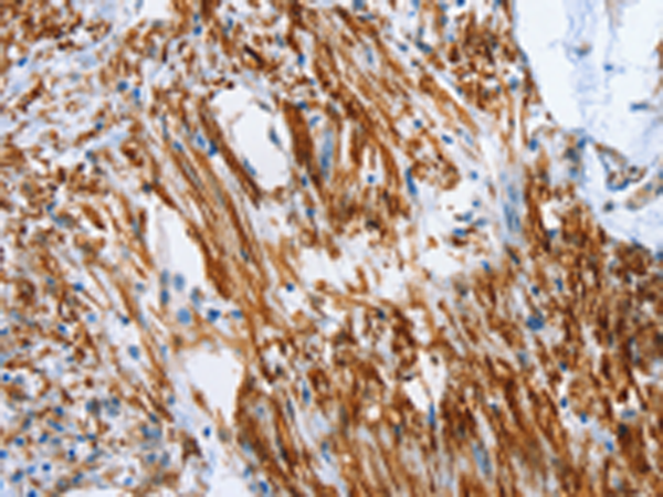 Immunohistochemistry of paraffin-embedded Human colon cancer tissue using TA350866 (SHROOM2 Antibody) at dilution 1/50 (Original magnification: x200)