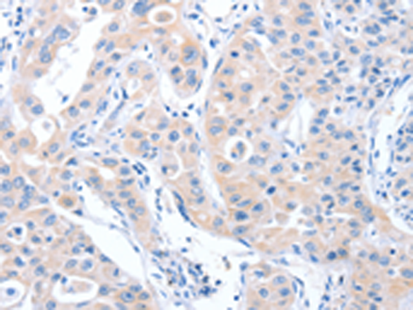 Immunohistochemistry of paraffin-embedded Human lung cancer tissue using TA350868 (ARHGEF6 Antibody) at dilution 1/70 (Original magnification: x200)