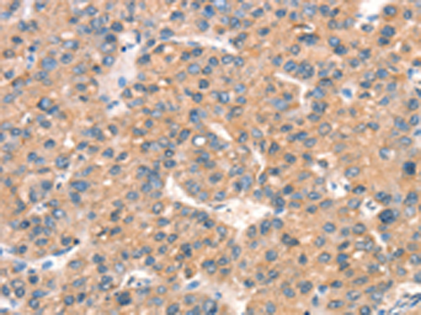 Immunohistochemistry of paraffin-embedded Human liver cancer tissue using TA350882 (ARHGAP4 Antibody) at dilution 1/25 (Original magnification: x200)