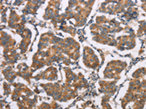 Immunohistochemistry of paraffin-embedded Human breast cancer tissue using TA350937 (ELP3 Antibody) at dilution 1/35 (Original magnification: x200)