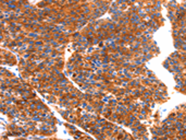Immunohistochemistry of paraffin-embedded Human liver cancer tissue using TA350948 (SEPTIN4 Antibody) at dilution 1/50 (Original magnification: x200)