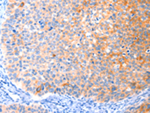 Immunohistochemistry of paraffin-embedded Human cervical cancer tissue using TA350966 (CCDC88A Antibody) at dilution 1/50 (Original magnification: x200)
