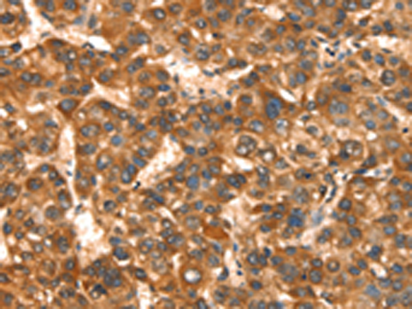 Immunohistochemistry of paraffin-embedded Human liver cancer tissue using TA351021 (CACNA1E Antibody) at dilution 1/15 (Original magnification: x200)