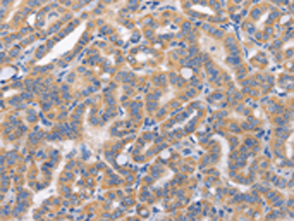 Immunohistochemistry of paraffin-embedded Human thyroid cancer tissue using TA351032 (CARD17 Antibody) at dilution 1/50 (Original magnification: x200)