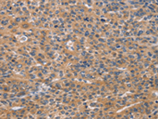 Immunohistochemistry of paraffin-embedded Human liver cancer tissue using TA351046 (NCR2 Antibody) at dilution 1/60 (Original magnification: x200)