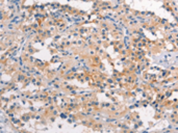 Immunohistochemistry of paraffin-embedded Human thyroid cancer tissue using TA351104 (TDGF1 Antibody) at dilution 1/15 (Original magnification: x200)