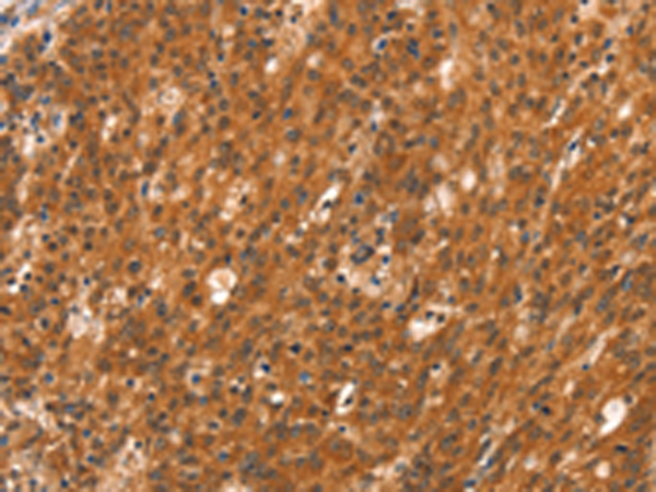 Immunohistochemistry of paraffin-embedded Human gasrtic cancer tissue using TA351123 (DAB2IP Antibody) at dilution 1/40 (Original magnification: x200)