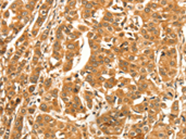 Immunohistochemistry of paraffin-embedded Human breast cancer tissue using TA351142 (DIRAS1 Antibody) at dilution 1/52 (Original magnification: x200)