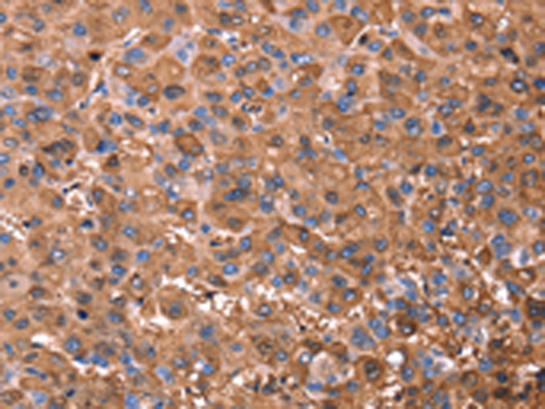 Immunohistochemistry of paraffin-embedded Human liver cancer tissue using TA351166 (ERN2 Antibody) at dilution 1/40 (Original magnification: x200)