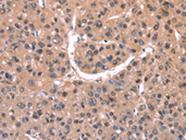 Immunohistochemistry of paraffin-embedded Human liver cancer tissue using TA351177 (EXTL1 Antibody) at dilution 1/20 (Original magnification: x200)