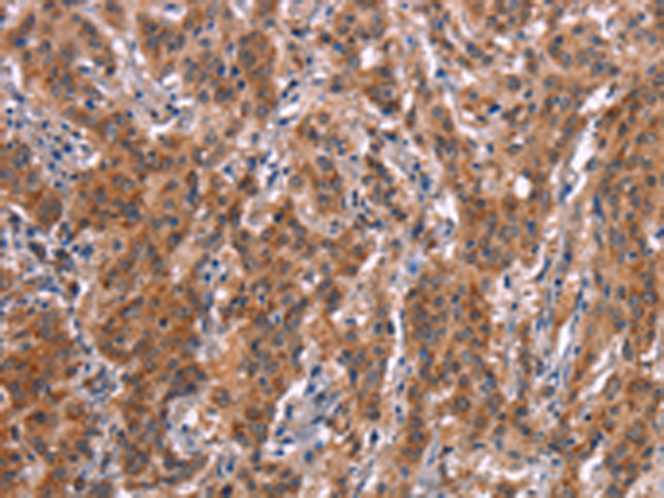 Immunohistochemistry of paraffin-embedded Human gasrtic cancer tissue using TA351184 (FDCSP Antibody) at dilution 1/25 (Original magnification: x200)